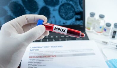 ABD’de Mpox’un yeni varyantından ilk vaka bildirildi