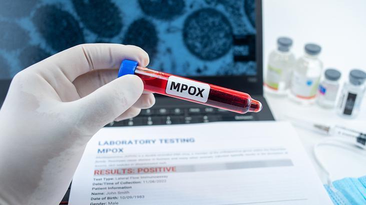 ABD’de Mpox’un yeni varyantından ilk vaka bildirildi