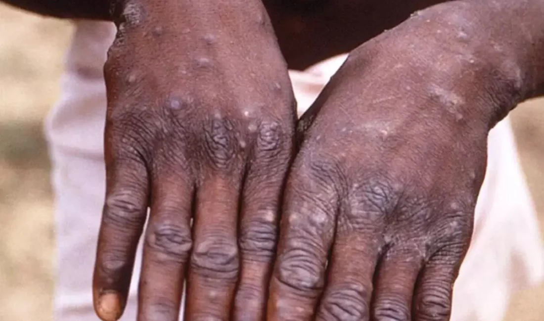 Uganda’da Temmuz 2024’ten bu yana M çiçeği virüsü (mpox) nedeniyle
