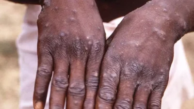 Uganda’da Temmuz 2024’ten bu yana M çiçeği virüsü (mpox) nedeniyle