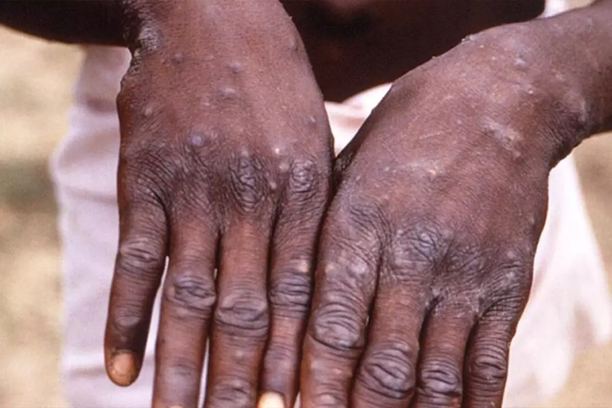 Uganda’da Temmuz 2024’ten bu yana M çiçeği virüsü (mpox) nedeniyle