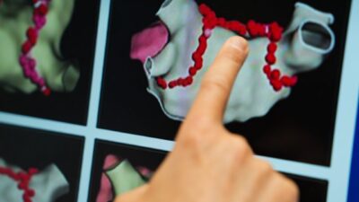 İSTANBUL, – KALP ritim bozukluklarının sık karşılaşılan bir sağlık problemi